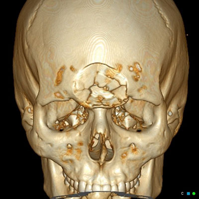 3D-CT