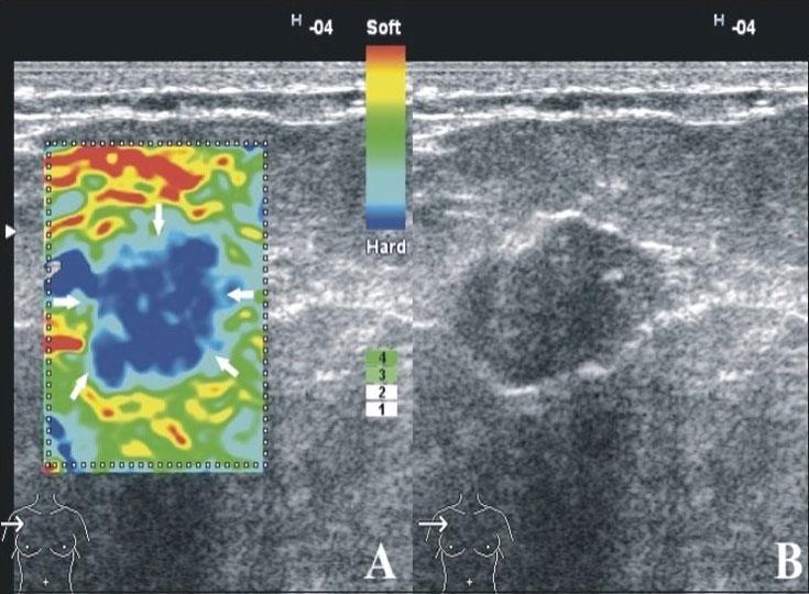 breast-elastography