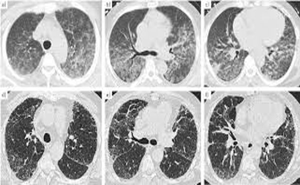 ct-chest