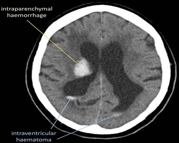 ct-head