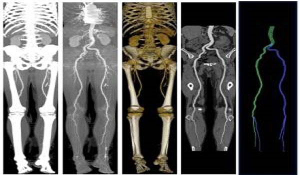 ct-peripheral-angiography