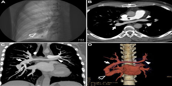 ct-pulmonary-angiography