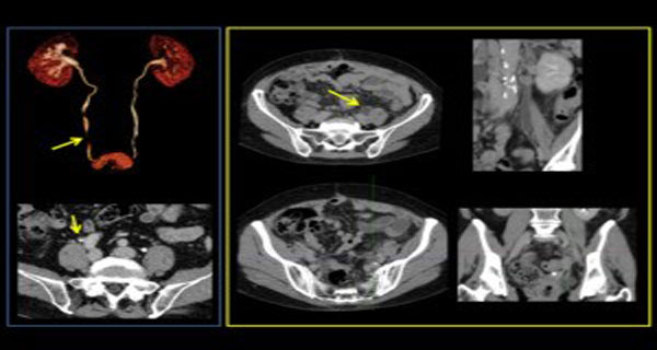 ct-urography