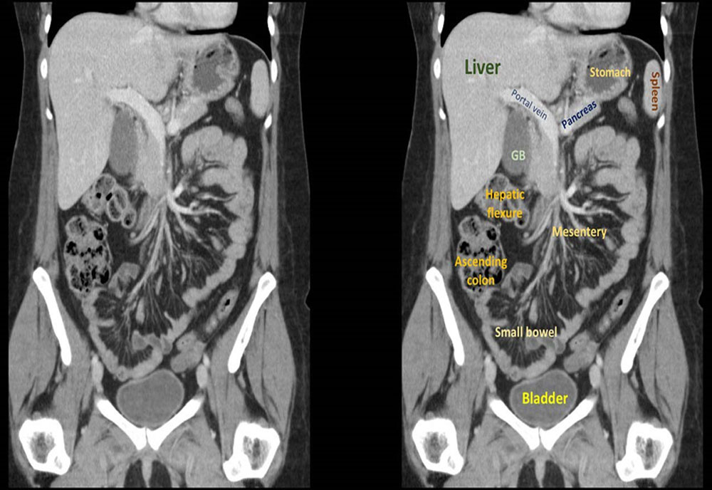 ct-whole-abdomen