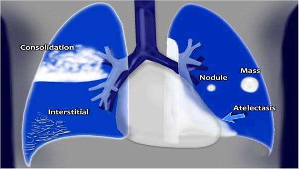 x-ray-chest